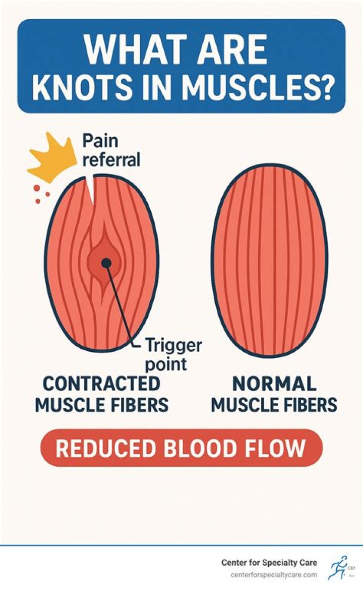 Are muscle knots painful?
