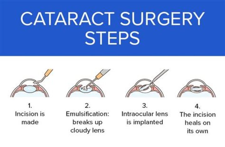 At what stage should cataracts be removed?