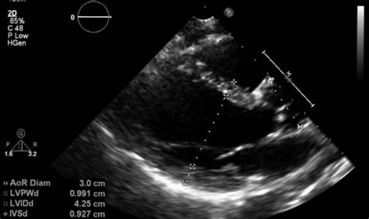 Can anxiety affect echocardiogram results?