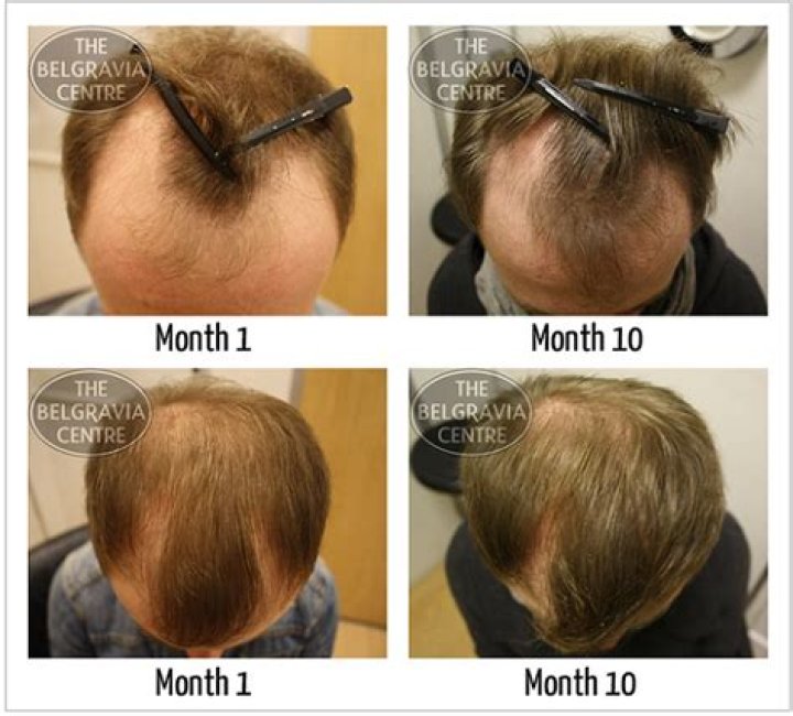How do I know if my hair is thinning?
