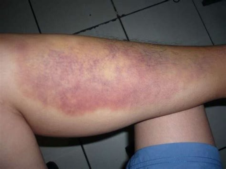 How do they treat a blood clot in the leg?