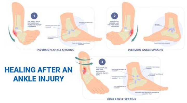 Should I ice my sprained ankle?